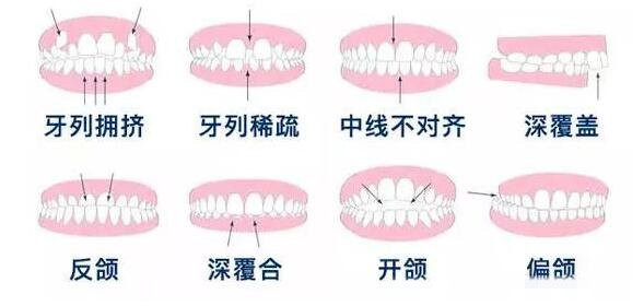 5类人不能做牙齿整形（牙齿矫正多大年龄是最佳时间）-第2张图片-飞扬号