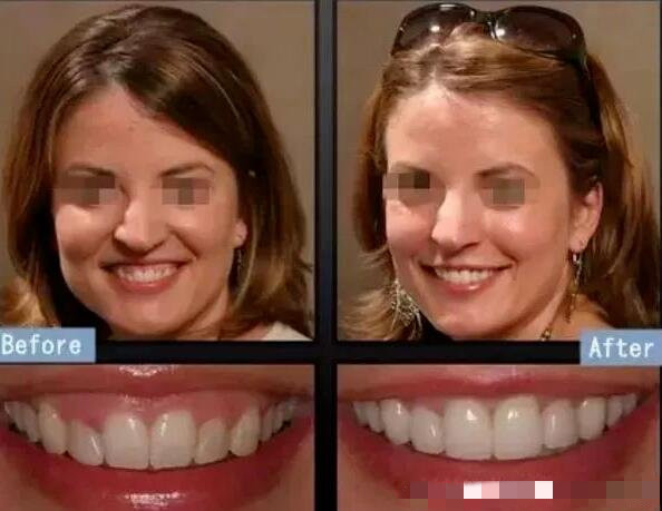 5类人不能做牙齿整形（牙齿矫正多大年龄是最佳时间）-第3张图片-飞扬号