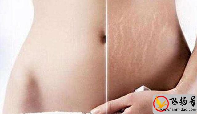 怀孕多久会长妊娠纹（为什么会长妊娠纹）-第2张图片-飞扬号